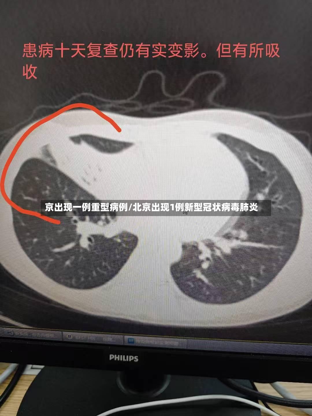 京出现一例重型病例/北京出现1例新型冠状病毒肺炎
