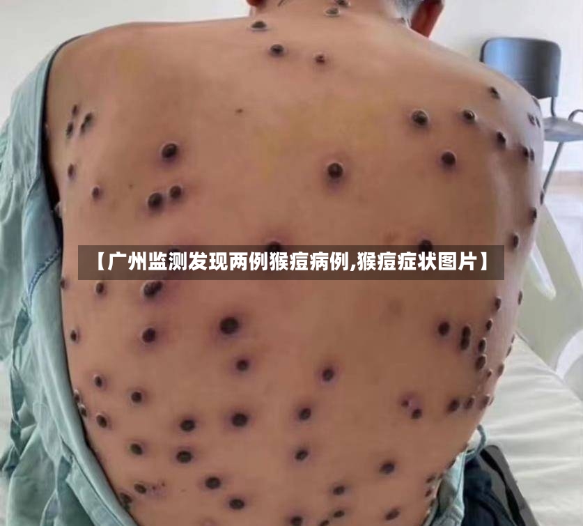 【广州监测发现两例猴痘病例,猴痘症状图片】
