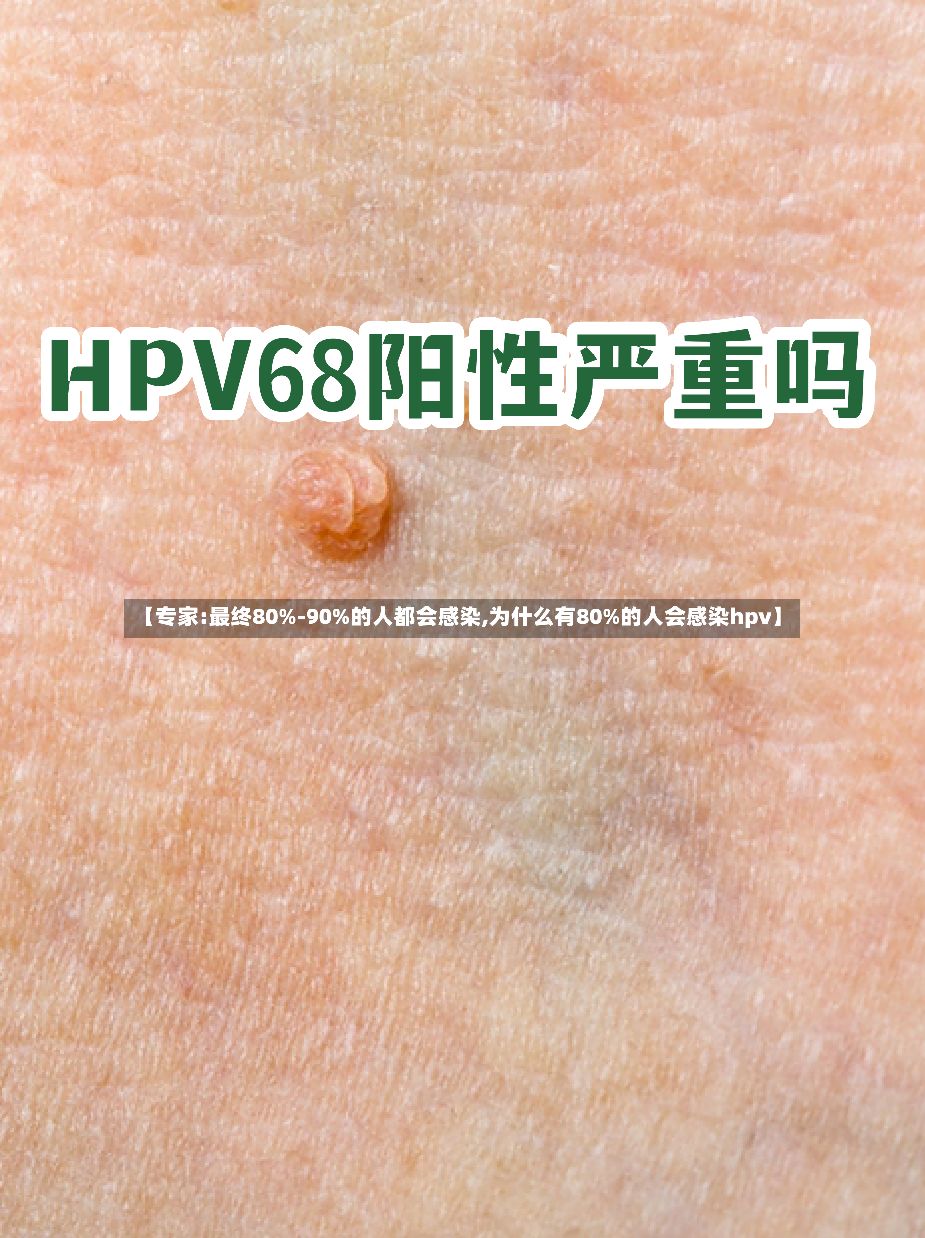 【专家:最终80%-90%的人都会感染,为什么有80%的人会感染hpv】-第2张图片
