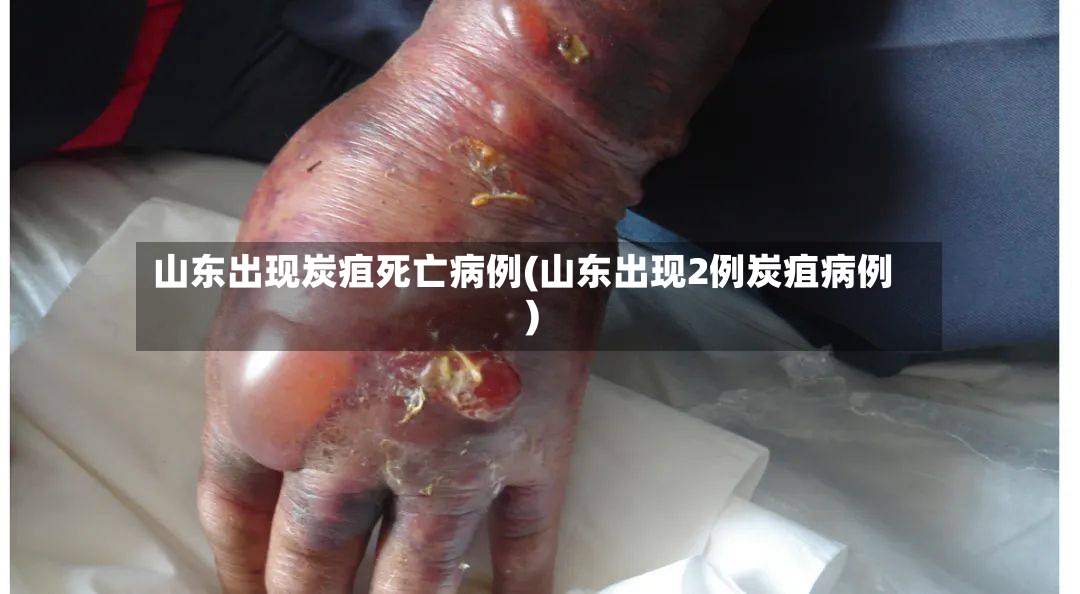 山东出现炭疽死亡病例(山东出现2例炭疽病例)